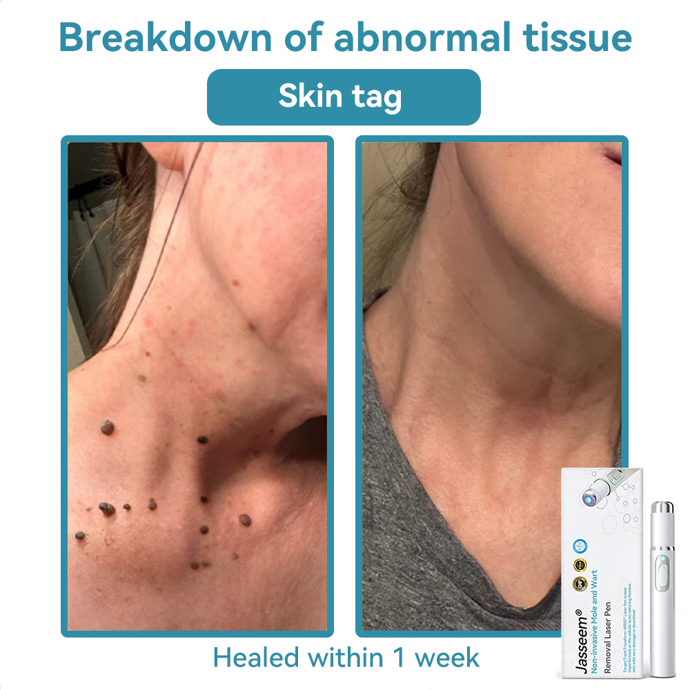 𝐉𝐚𝐬𝐬𝐞𝐞𝐦® Medical-Grade Laser Pen 🎉 (Powered by CO₂ laser technology – effectively removes moles, warts, skin tags, pigmentation spots, and other skin imperfections)