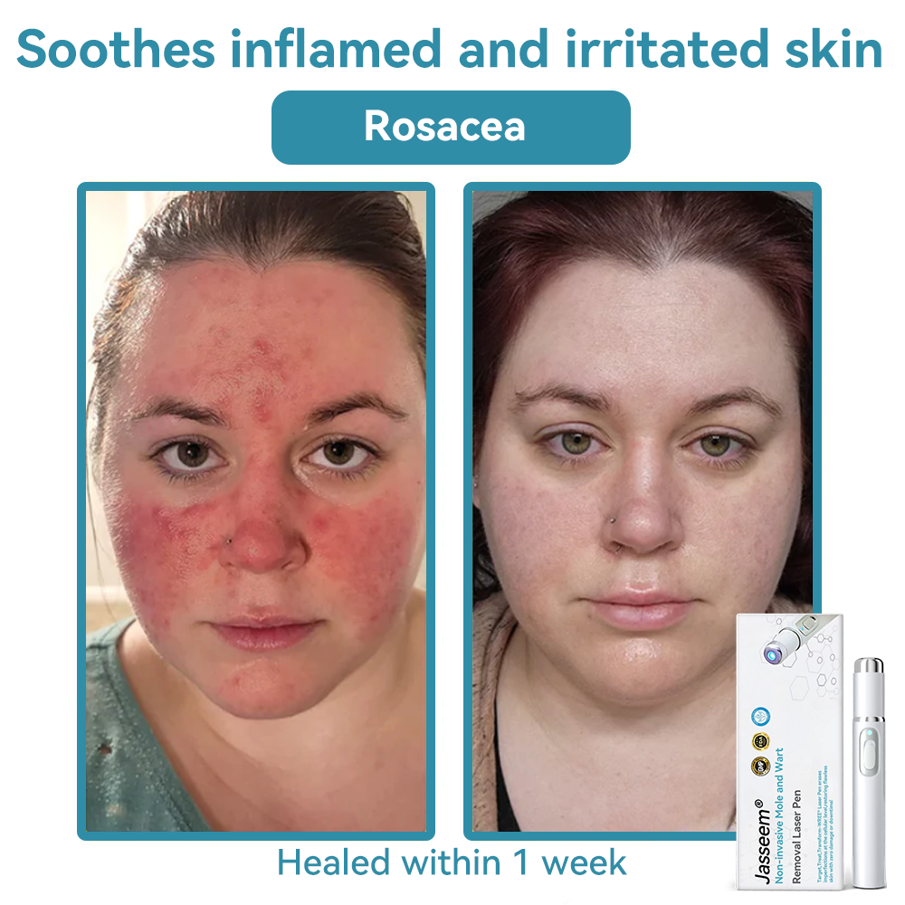 𝐉𝐚𝐬𝐬𝐞𝐞𝐦® Medical-Grade Laser Pen 🎉 (Powered by CO₂ laser technology – effectively removes moles, warts, skin tags, pigmentation spots, and other skin imperfections)