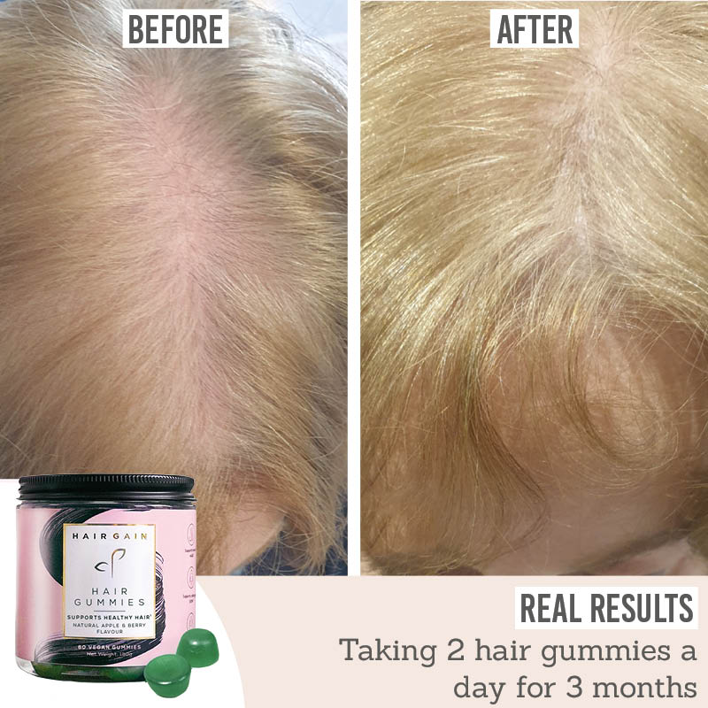 Hair Gummies